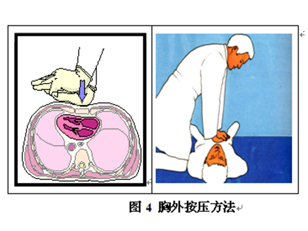 心肺復蘇五個注意事項